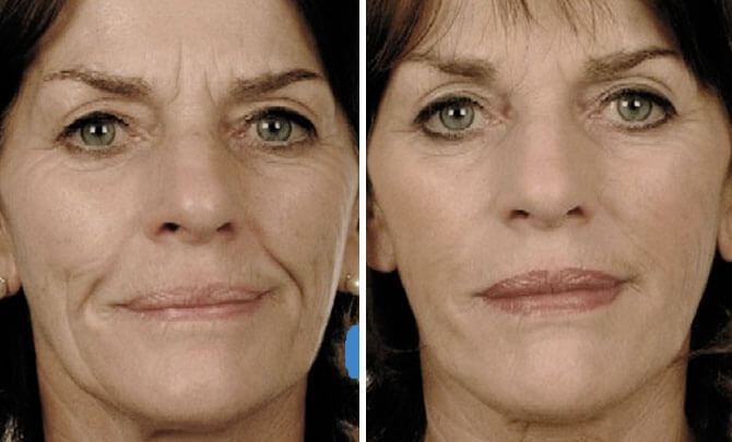 Facial Injectable Fillers 120